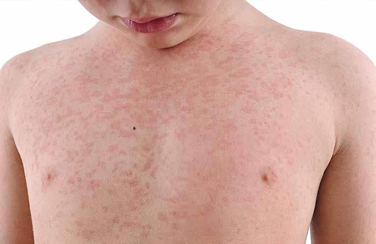 Measles is about – check that your immunisations are up to date